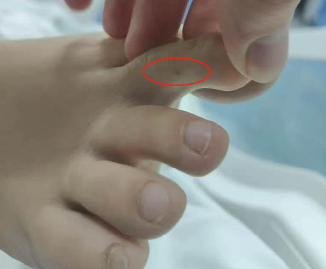 子”死亡记录：曾诊断为不明生物咬伤(神经毒蛇) 等麻将胡了免费试玩“三亚旅游被不明物咬伤身亡27岁女(图4)